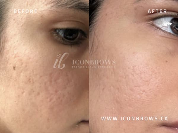 Microneedling for acne and scarring by Iconbrows Toronto.