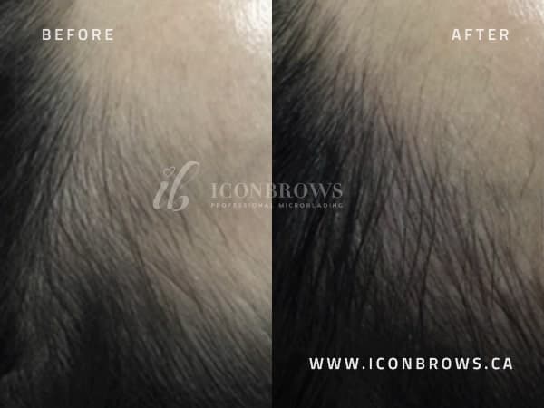 Hairline Recovery By Iconbrows.