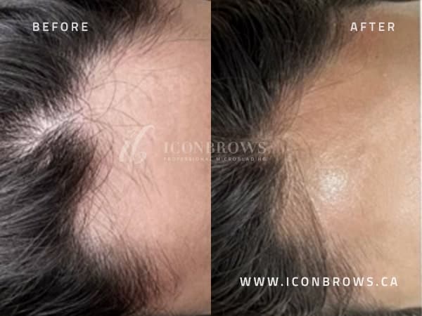 Toronto Hairline Correction By Iconbrows.