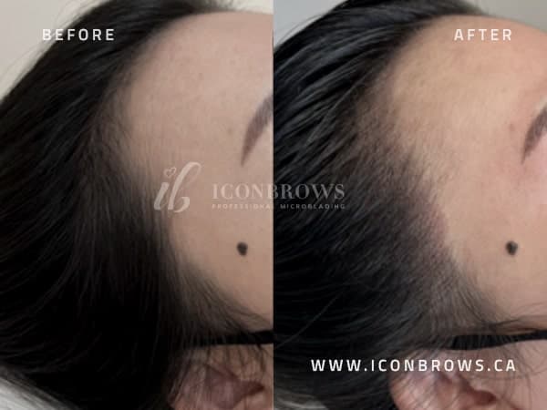 Hairline Correction on Woman.