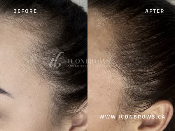 Hairline Correction Done in Toronto Ontario.