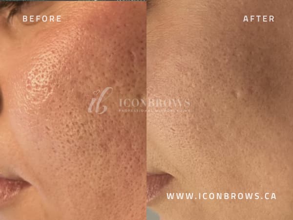 face acne healing from microneedling with iconbrows.