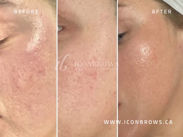 different stages of acne and face scar healing from iconbrows microneedling.