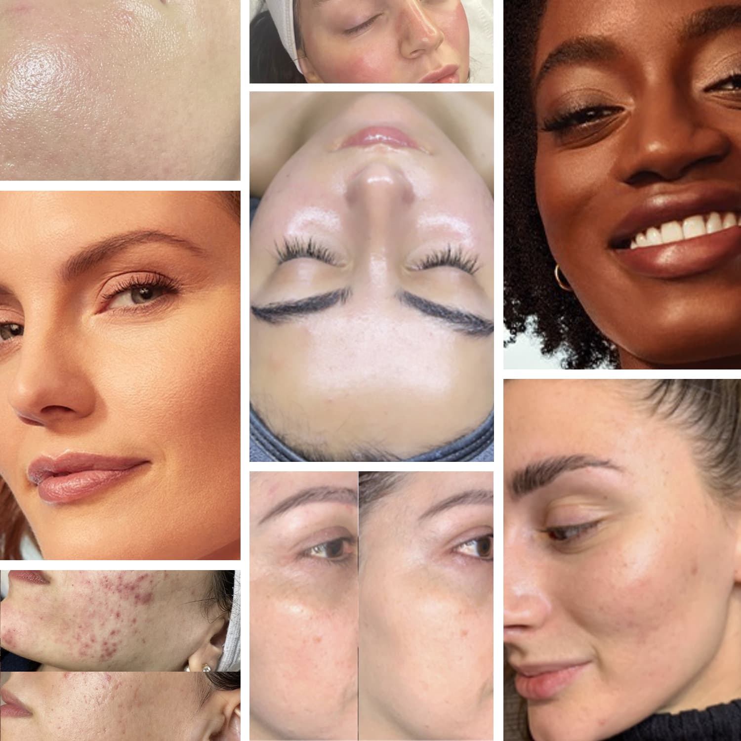 IconBrows Service Main Image MicroReju Revitalizing Facial Toronto DeAge Rejuvenate Skin