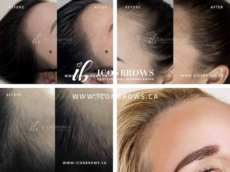 Permanent Makeup Hairline Correction Cover Up done by Iconbrows - Professional Microblading in Toronto Ontario M8V 0C8.