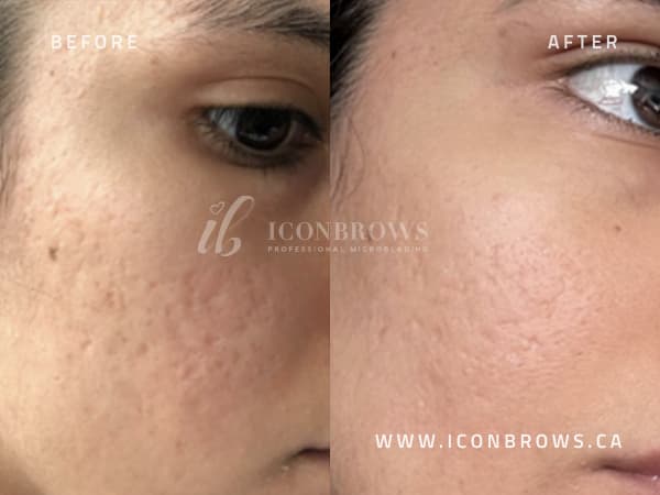 face acne healing from microneedling with iconbrows.